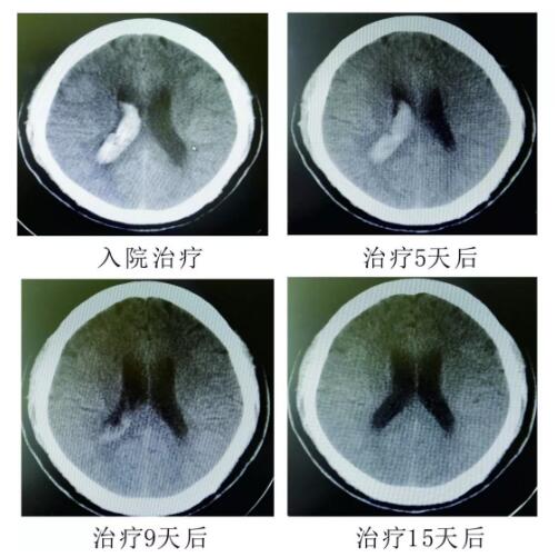 腦出血你不得不引起重視的疾病?。?！