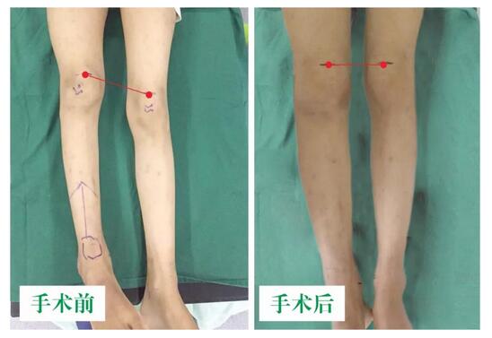 女孩墜梯右腿縮短5cm，幸得醫(yī)生及時(shí)診治恢復(fù)正常腿型