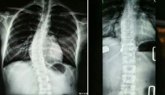 好好的脊柱怎么說彎就彎了？你竟然都沒發(fā)現(xiàn)……