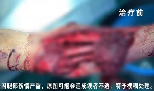 感謝安利醫(yī)院挽救了我的腿，沒有讓我落下殘疾……”