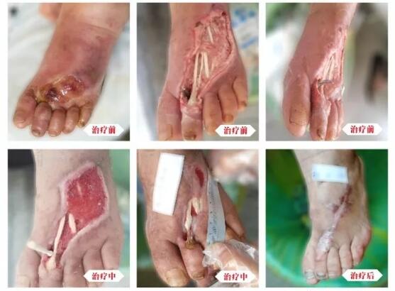 糖尿病并發(fā)癥有多可怕，及時(shí)治療糖尿病足避免截肢！