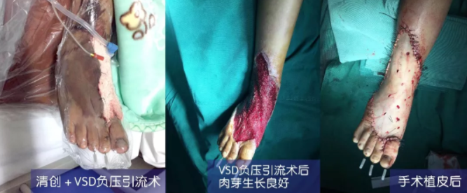 車禍猛如虎，救治如“華佗” ，手術(shù)＋康復(fù)，8歲小女孩車禍后日漸康復(fù)行走