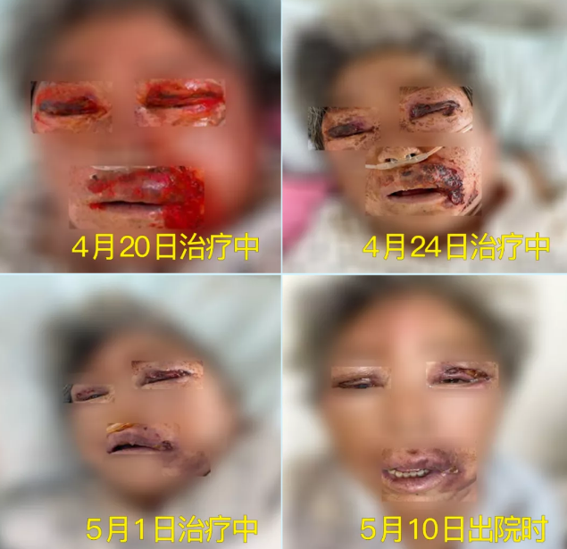 膿毒血癥（急性頜面部蜂窩組織炎）多學(xué)科聯(lián)合會診，幫助患者成功治愈！