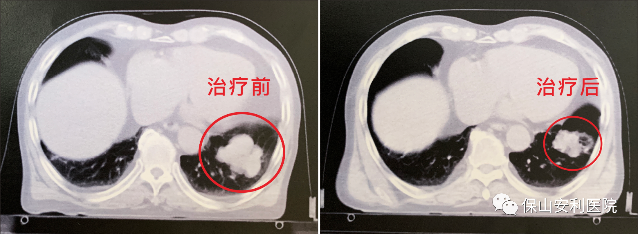 不做手術(shù)，早期肺癌也能根治！