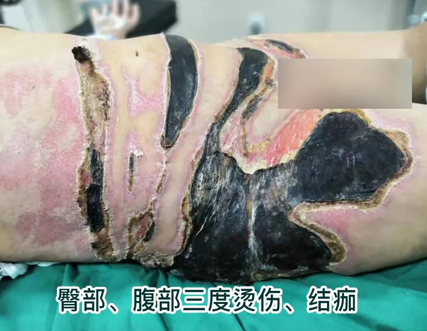 【保山安利醫(yī)院】80歲老人不慎燒傷，導(dǎo)致腹部、右側(cè)臀部大面積創(chuàng)傷，經(jīng)植皮治療創(chuàng)面逐漸愈合
