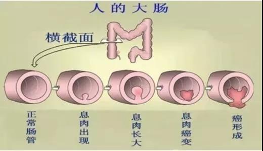 體檢發(fā)現(xiàn)腸息肉會(huì)癌變嗎？