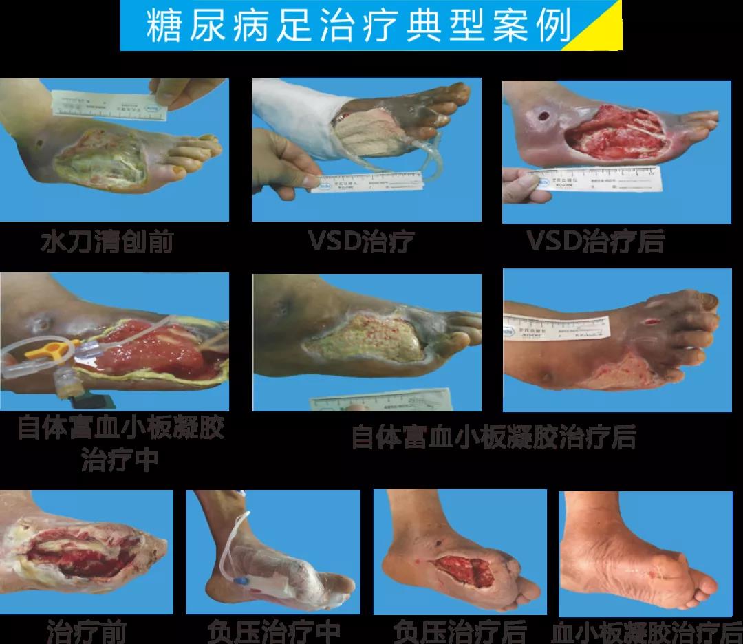 截肢、失明，甚至……，我們要做的是將糖尿病并發(fā)癥遏制在搖籃里！