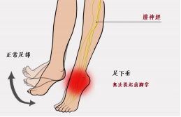 【保山安利醫(yī)院—健康科普】什么是足下垂！你了解嗎？
