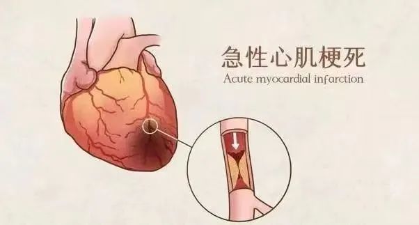 【保山安利醫(yī)院】11月20日“心梗救治日” 時(shí)間就是心肌，時(shí)間就是生命！